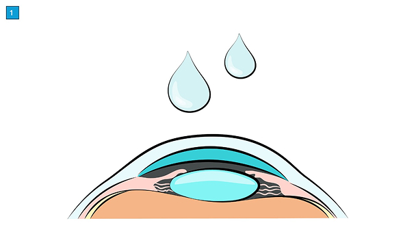 miol-linsenimplantation-ablauf-focuslaser-zuerich3
