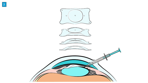 miol-linsenimplantation-ablauf-focuslaser-zuerich4