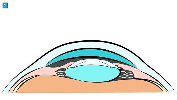 miol-linsenimplantation-ablauf-focuslaser-zuerich5