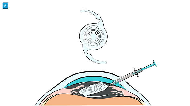 miol-linsenimplantation-ablauf-focuslaser-zuerich7