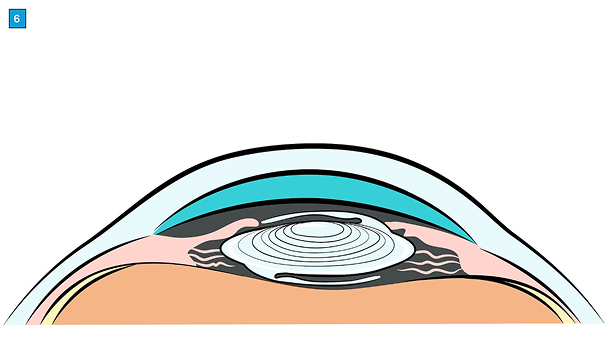 miol-linsenimplantation-ablauf-focuslaser-zuerich8
